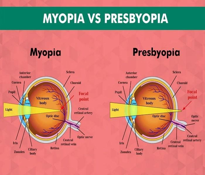 Presbyopia Symptoms, Risk Factors & Treatment | Diseases List A-Z