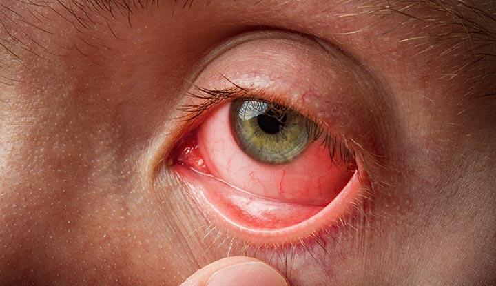 Conjunctivitis Symptoms, Risk Factors & Treatment | Diseases List A-Z