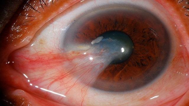 Pterygium Symptoms, Risk Factors & Treatment | Diseases List A-Z