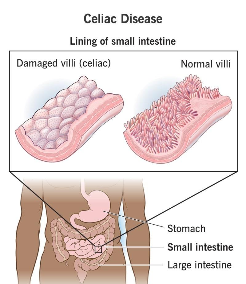 Celiac Disease Symptoms, Risk Factors & Treatment | Diseases List A-Z