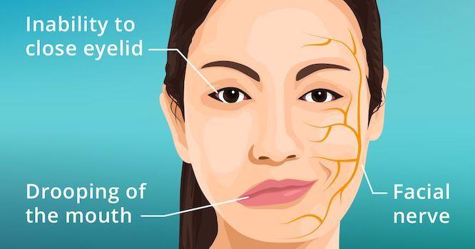 Bell’s Palsy Symptoms, Risk Factors & Treatment | Diseases List A-Z