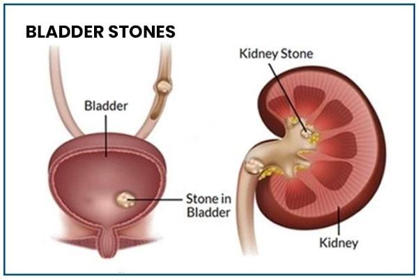 Bladder Stones Symptoms, Risk Factors & Treatment | Diseases List A-Z