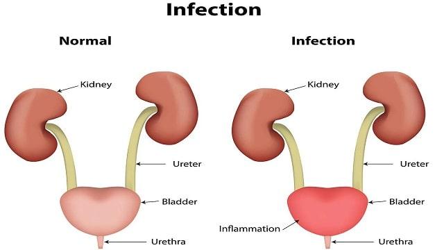 Urinary Tract Infection Symptoms, Risk Factors & Treatment | Diseases List A-Z