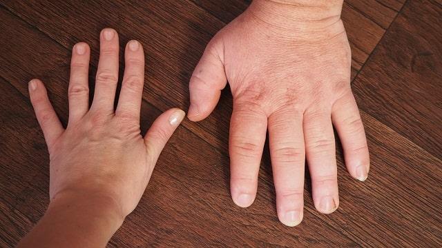 Acromegaly Symptoms, Risk Factors & Treatment | Diseases List A-Z