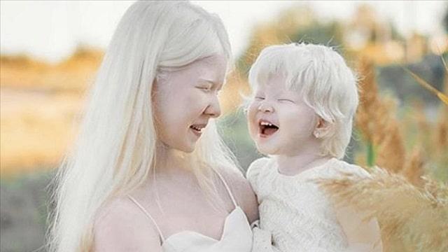 Albinism Symptoms, Risk Factors & Treatment | Diseases List A-Z