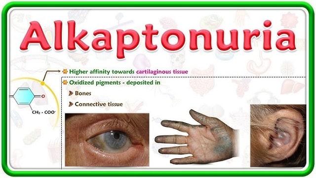 Alkaptonuria Symptoms, Risk Factors & Treatment | Diseases List A-Z