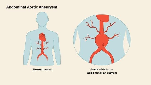 Aortic Aneurysm Symptoms, Risk Factors & Treatment | Diseases List A-Z