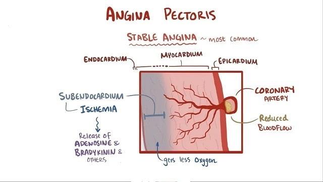 Angina Pectoris Symptoms, Risk Factors & Treatment | Diseases List A-Z