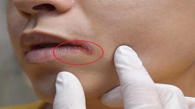 Angular Cheilitis Symptoms, Risk Factors & Treatment | Diseases List A-Z