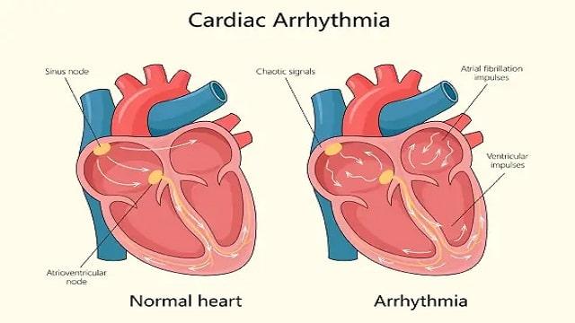 Arrhythmia Symptoms, Risk Factors & Treatment | Diseases List A-Z