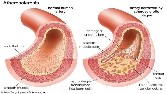 Arteriosclerosis Symptoms, Risk Factors & Treatment | Diseases List A-Z