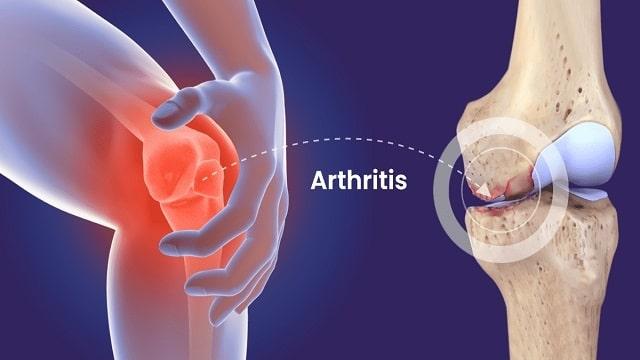 Arthritis Symptoms, Risk Factors & Treatment | Diseases List A-Z