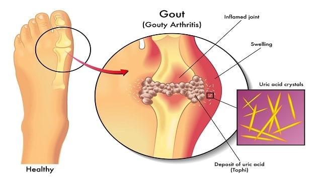 Gout Arthritis Symptoms, Risk Factors & Treatment | Diseases List A-Z