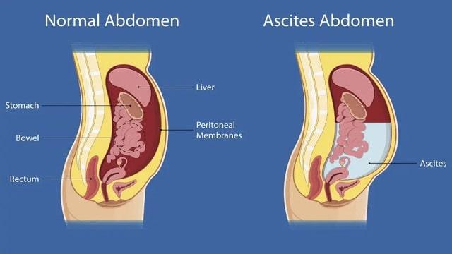 Ascites Symptoms, Risk Factors & Treatment | Diseases List A-Z