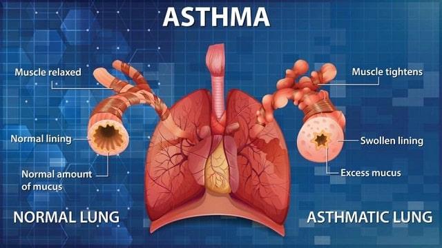 Asthma Symptoms, Risk Factors & Treatment | Diseases List A-Z