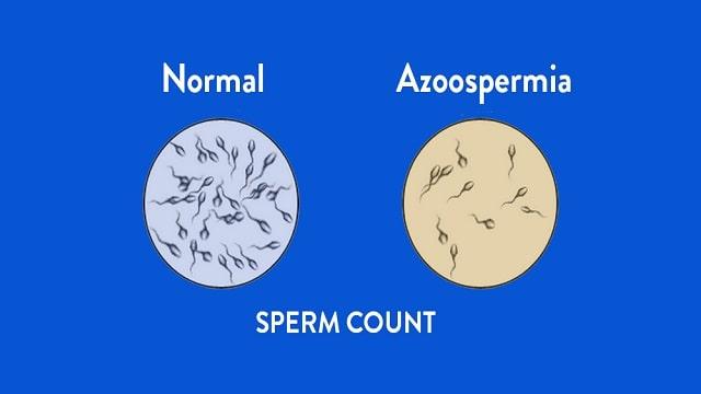 Azoospermia Symptoms, Risk Factors & Treatment | Diseases List A-Z