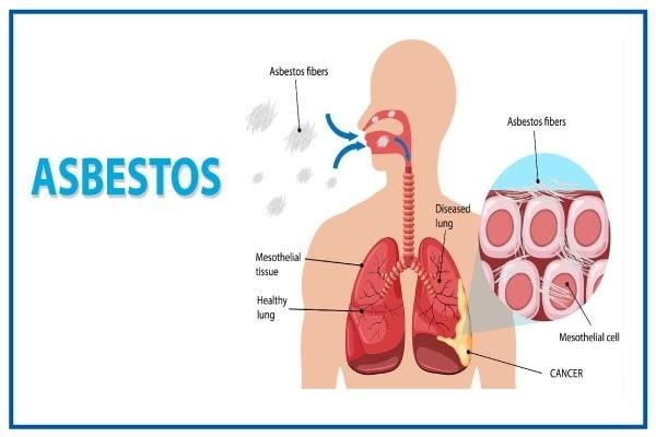 Asbestosis Symptoms, Risk Factors & Treatment | Diseases List A-Z