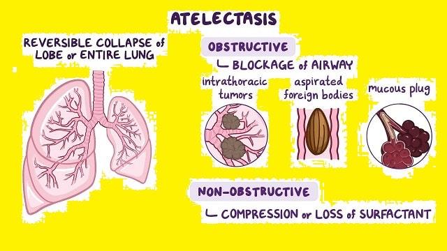 Atelectasis Symptoms, Risk Factors & Treatment | Diseases List A-Z