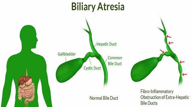 Biliary Atresia Symptoms, Risk Factors & Treatment | Diseases List A-Z