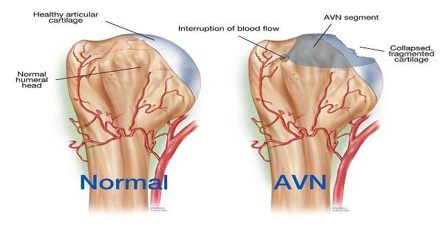 Avascular Necrosis Symptoms, Risk Factors & Treatment | Diseases List A-Z