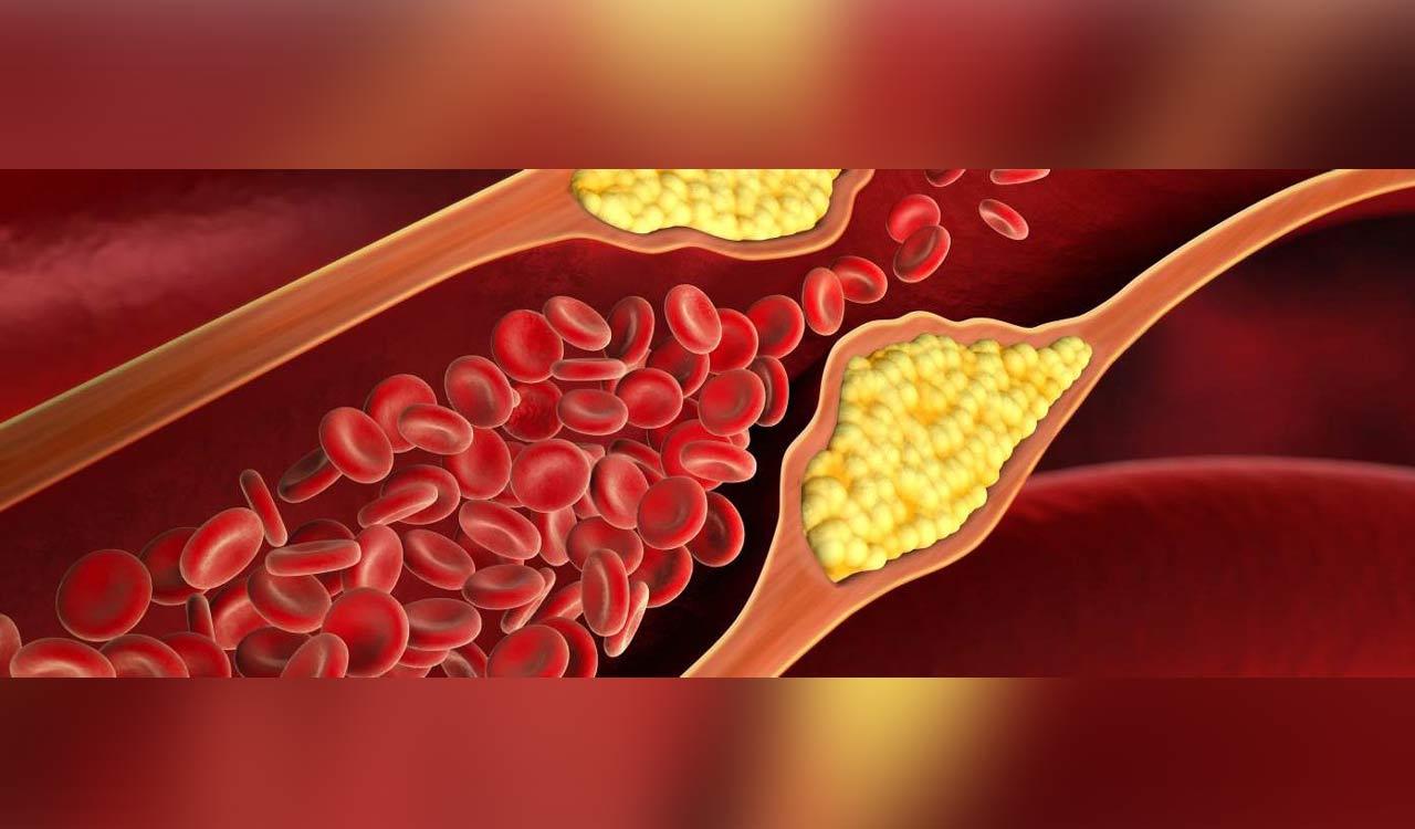 Covid infection linked to 30pc increased risk of Dyslipidemia, study finds