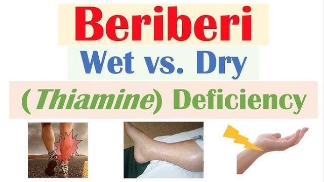 Beriberi Symptoms, Risk Factors & Treatment | Diseases List A-Z