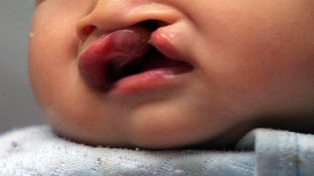 Cleft Lip Symptoms, Risk Factors & Treatment | Diseases List A-Z