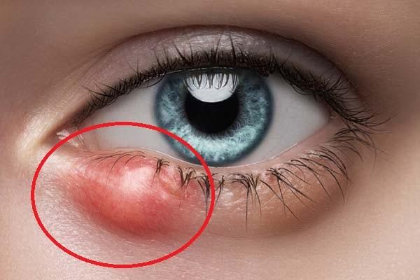 Stye Symptoms, Risk Factors & Treatment | Diseases List A-Z