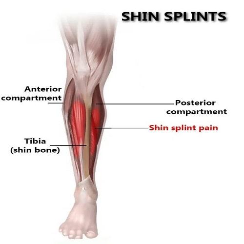 Shin Splints Symptoms, Risk Factors & Treatment | Diseases List A-Z