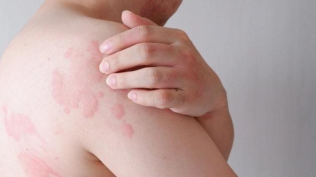 Hives Symptoms, Risk Factors & Treatment | Diseases List A-Z