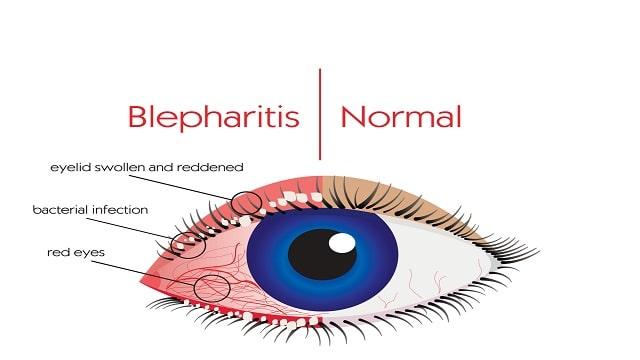 Blepharitis Symptoms, Risk Factors & Treatment | Diseases List A-Z