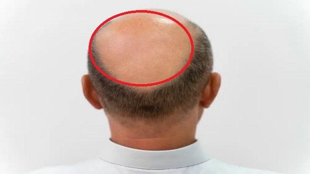 Baldness Symptoms, Risk Factors & Treatment | Diseases List A-Z