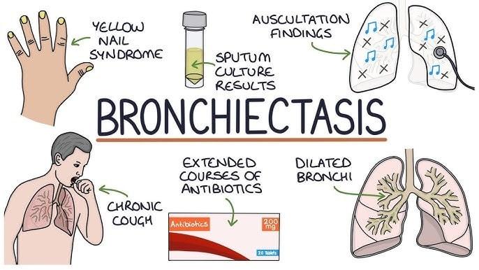 Bronchiectasis Symptoms, Risk Factors & Treatment | Diseases List A-Z