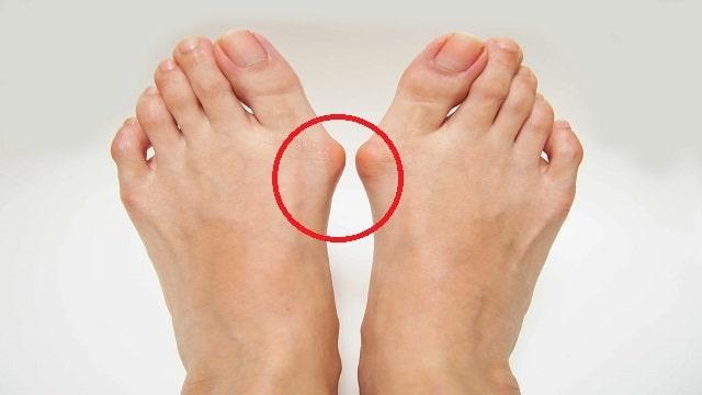 Bunions Symptoms, Risk Factors & Treatment | Diseases List A-Z