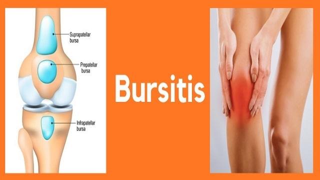 Bursitis Symptoms, Risk Factors & Treatment | Diseases List A-Z