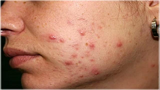 Pimples Symptoms, Risk Factors & Treatment | Diseases List A-Z